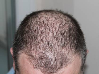 Cura della calvizie: nell’80% dei pazienti i capelli ricrescono