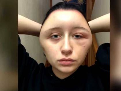 Ha una reazione allergica dopo tintura per capelli: la faccia si gonfia di 63 cm