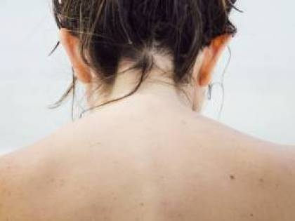 Allergia al sole, quali sono i sintomi e come si cura