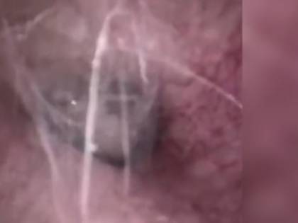 Ragno nell'orecchio di paziente, scoperta choc di un medico in Cina