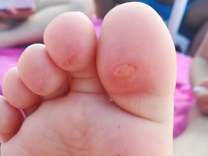 Pareo Park, 150 bambini colpiti da infezione: bolle e sangue sui piedi