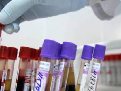 Nasconde di avere l'Hiv alla compagna e lei muore, arrestato 55enne