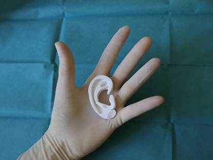 Ricostruito l'orecchio di un bambino con la stampa 3D