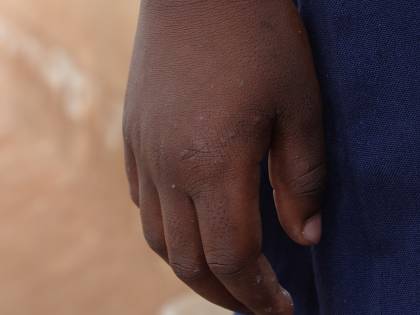 "Sei solo una scimmia". La follia dei razzisti contro una ragazza