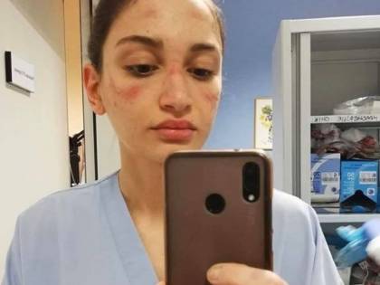 L'infermiera con il volto segnato dalla mascherina: "State in casa"