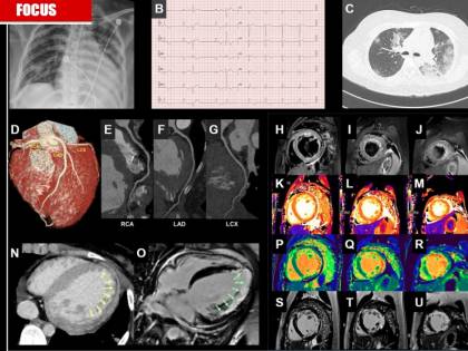 Covid-19, triplicati i morti per infarto. Ma è tutta colpa del virus?