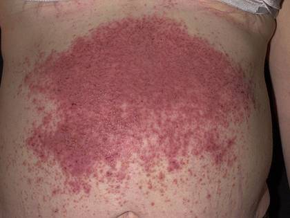 Dermatite erpetiforme, quali sono le cause