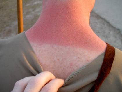 Eritema solare, ecco alcuni rimedi per curare la pelle
