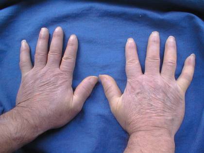 Sclerodermia, di cosa si tratta e come si manifesta