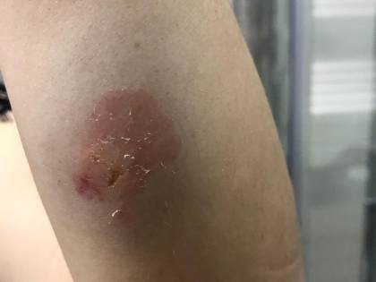 Infermiera aggredita a morsi nell'ospedale di Frattamaggiore. Escoriazioni al braccio