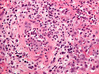 Granulomatosi di Wegener, di cosa si tratta?
