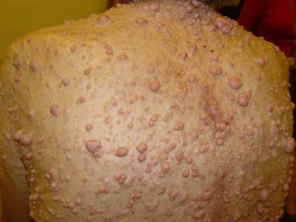 Neurofibromatosi tipo 2: cosa è questa malattia