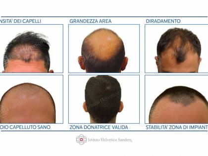 Trapianto di capelli, in Italia è meglio che all'estero?