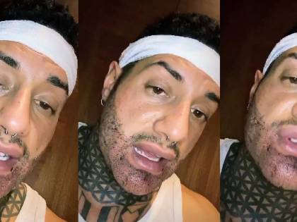 Chiofalo fa il trapianto di barba: ma il post-operazione diventa uno show