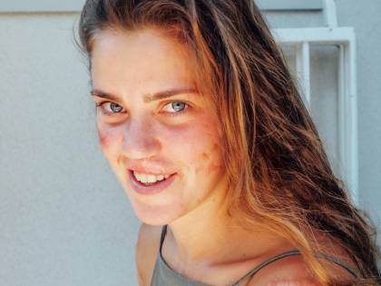 "Con le mie cicatrici sono una bellezza unica. E ora ho fame di vita"
