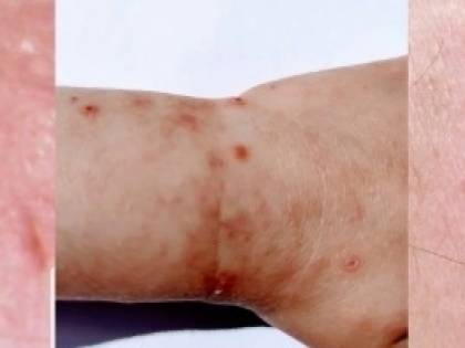 I 6 segni sulla nostra pelle che annunciano il contagio da Covid