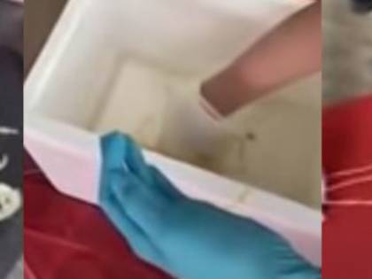 Un verme di 18 metri in pancia. La scoperta choc su un anziano