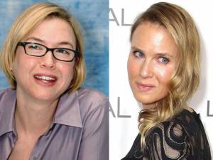 Renée Zellweger, prima e dopo la chirurgia