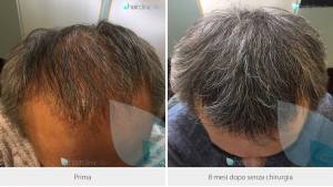 Medicina Rigenerativa per curare la calvizie: meglio del trapianto di capelli