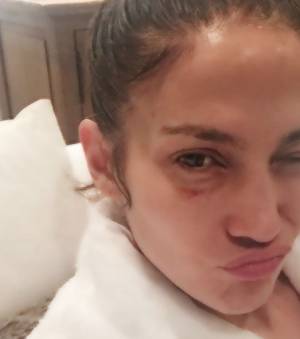 Jennifer Lopez, l'occhio nero che fa spaventare i follower