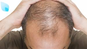 Trapianto Capelli, le Cellule Rigeneratrici lo potenziano o lo evitano