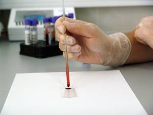 Basterà un esame del sangue per diagnosticare il tumore al seno