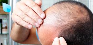 Trapianto Capelli, sai perché non risolve l’Alopecia?