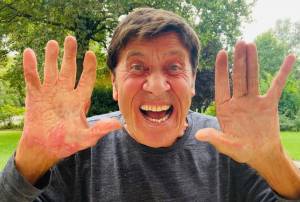 Gianni Morandi e la foto choc delle mani ustionate: "Impressionante"