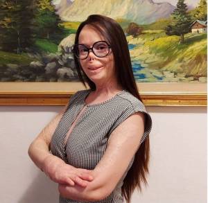 Valentina Pitzalis: "Il mio ex mi ha dato fuoco, ma io non ho perso il sorriso"