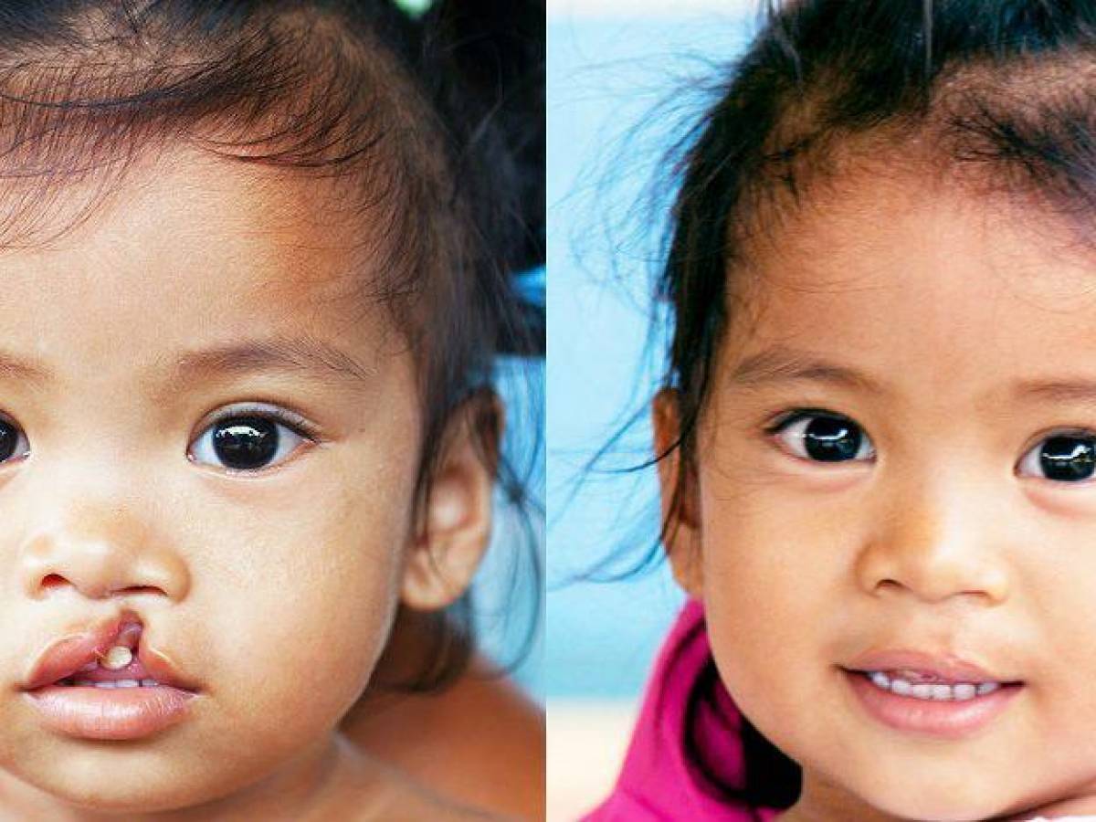 Bimbi all'aperto? Niente paura con i braccialetti anti-smarrimento di  Operation Smile