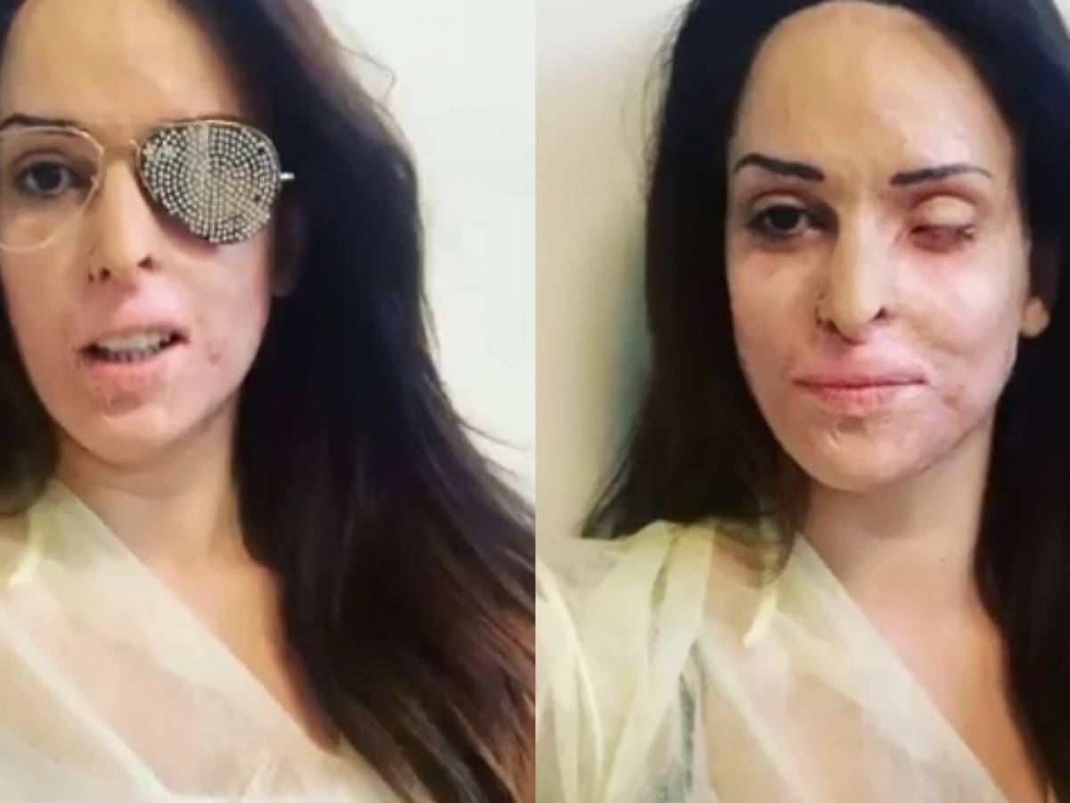 Лицо после кислоты фото Лицо после кислоты фото