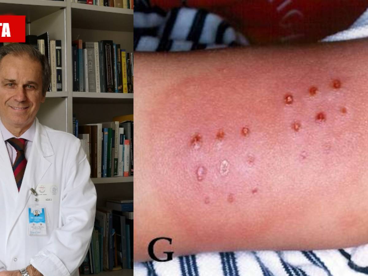 cosa c e dietro la sindrome di kawasaki che spaventa le famiglie ilgiornale it