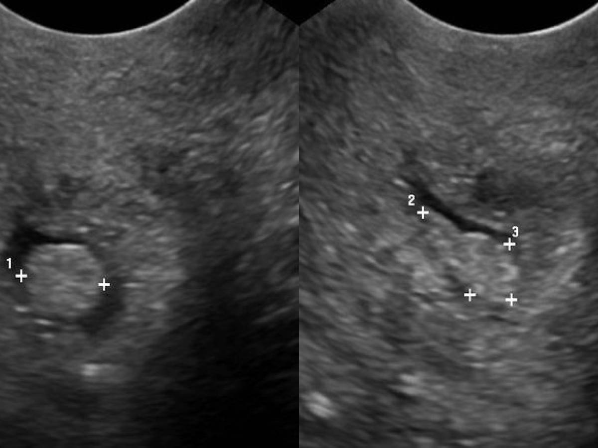 Эндометрий 1 мм. Полип эндометрия и цервикального канала.