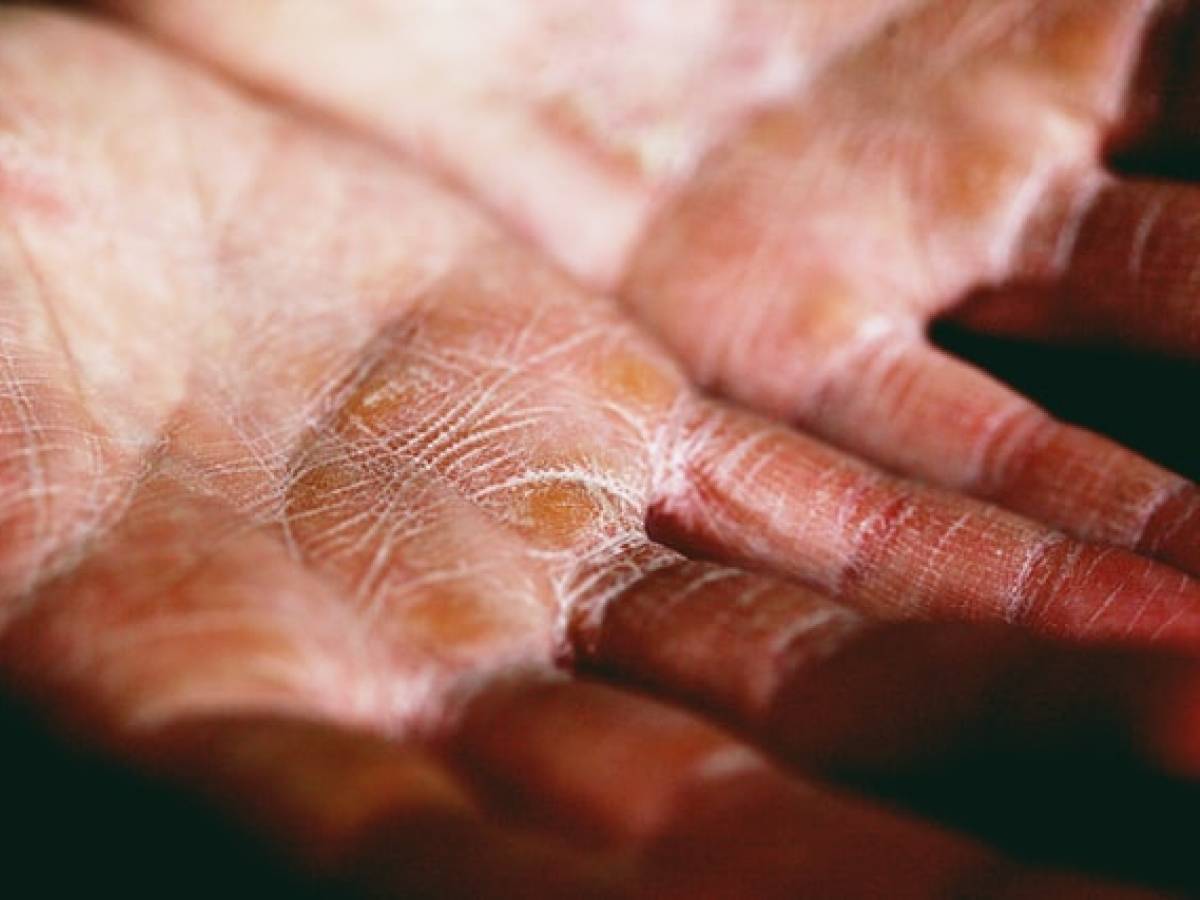 Mani con pelle secca