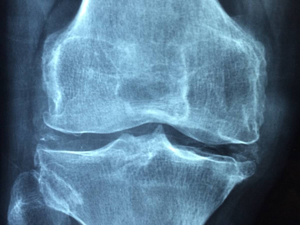 Radiografia ginocchio