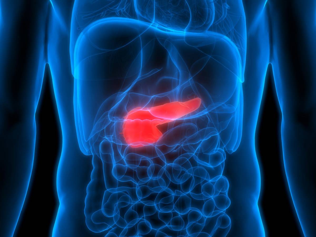 Tumore al pancreas, cosa sappiamo e cosa si può fare