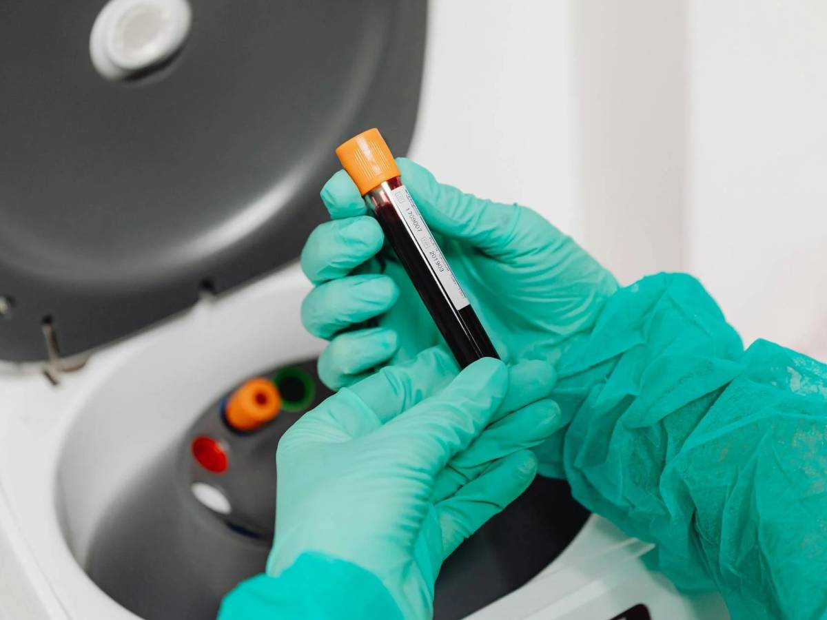 Colesterolo, come abbassare il temuto LDL. Occhio alla soglia di pericolo che cambia