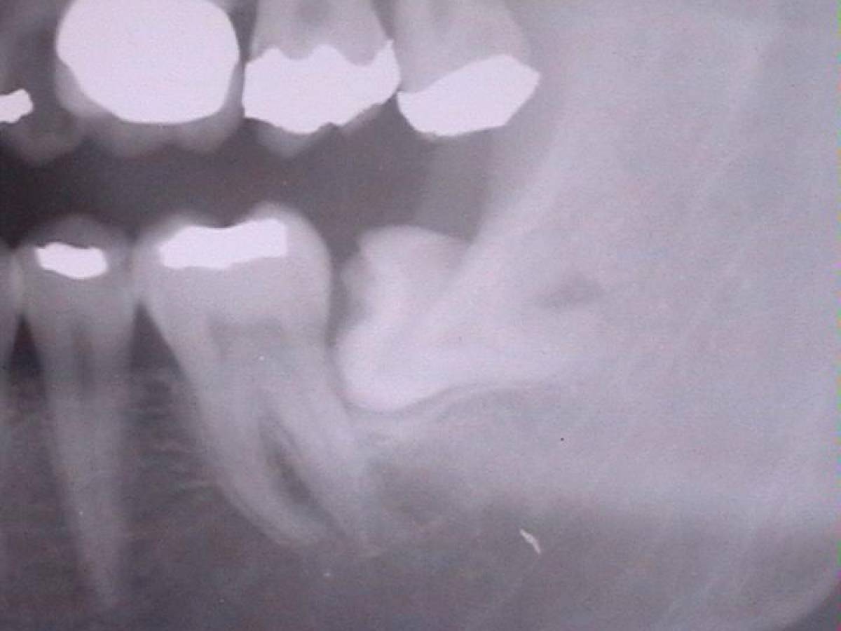 Denti del giudizio, non sempre è necessario rimuoverli. Ecco quando è necessario