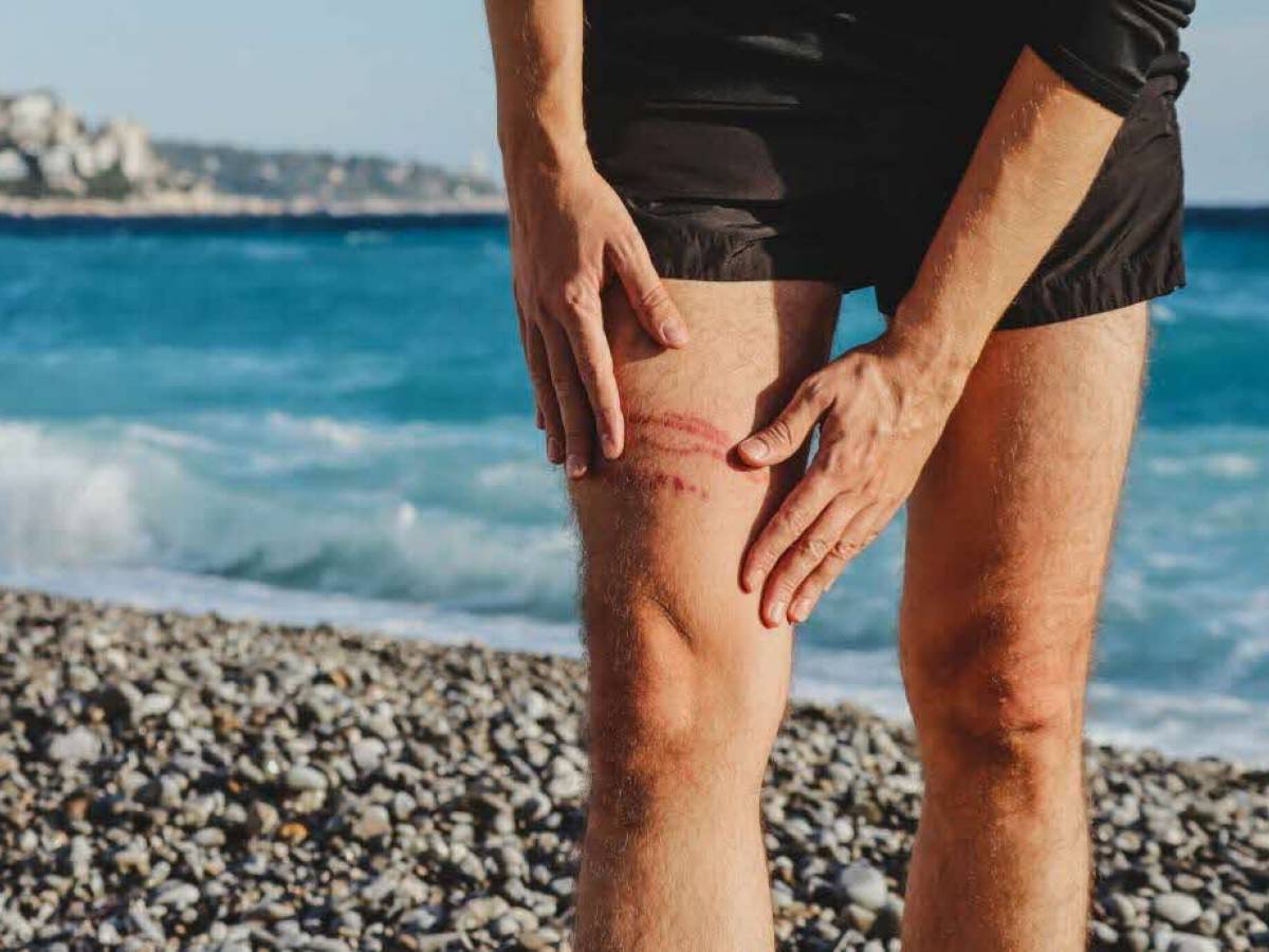 Meduse: cosa fare in caso di puntura? Meduse: cosa fare in caso di puntura?