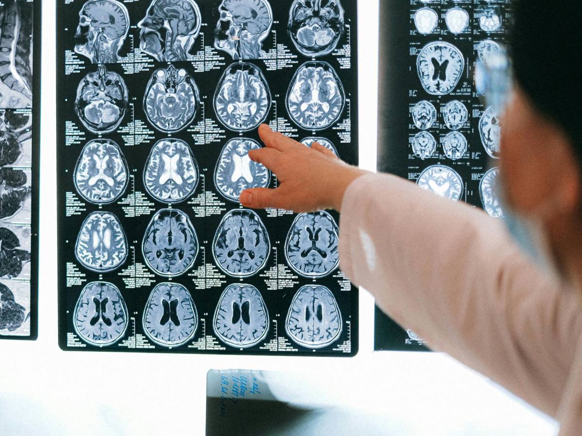 la regola fast tutti i segnali per intercettare l ictus