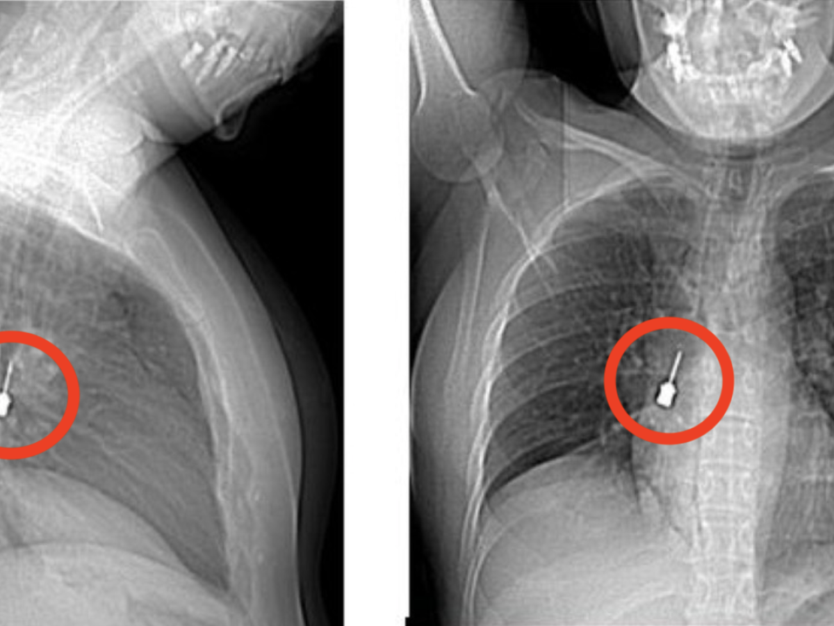 cacciavite odontoiatrico incastrato nei bronchi di una donna 200 stato inalato per sbaglio da Ilgiornale.it cacciavite odontoiatrico incastrato nei bronchi di una donna 200 stato inalato per sbaglio