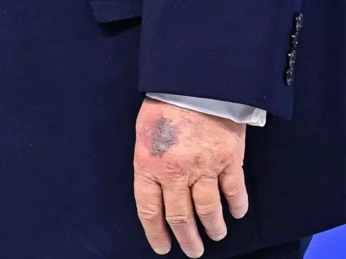 trump e quello strano livido sulla mano ecco che cosa fa preoccupare la casa bianca da Ilgiornale.it trump e quello strano livido sulla mano ecco che cosa fa preoccupare la casa bianca