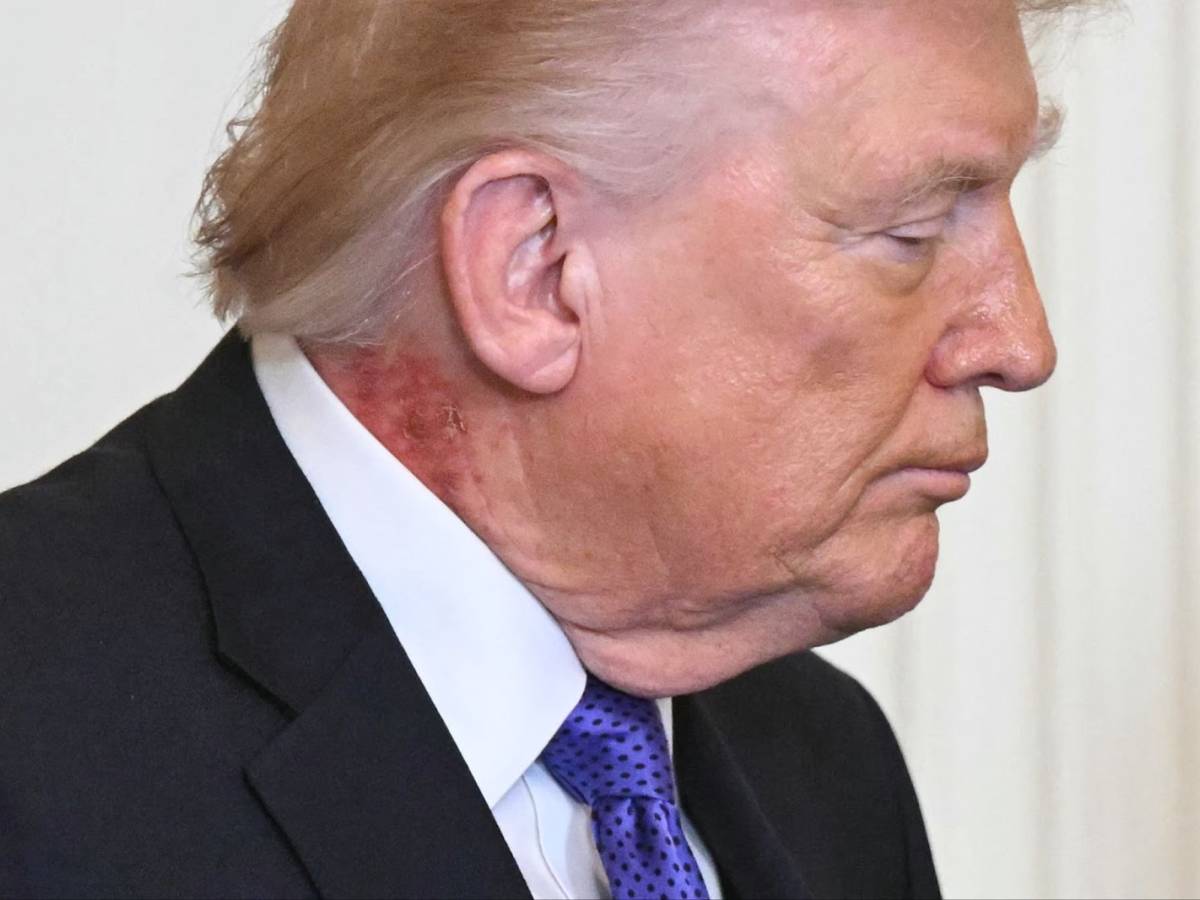 trump e il collo arrossato cosa 232 successo al presidente usa