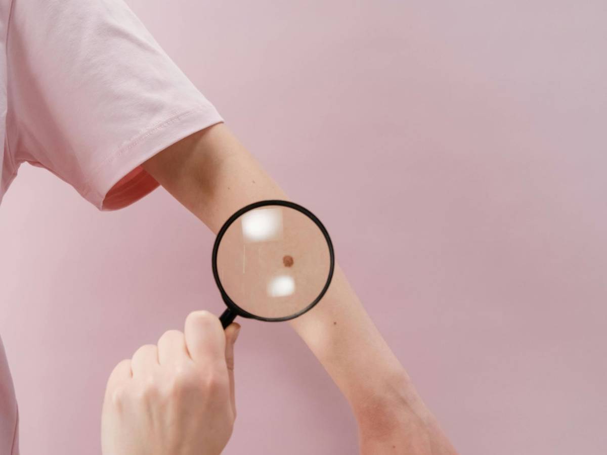 estate e zecche come riconoscere subito i sintomi della malattia di lyme da Ilgiornale.it estate e zecche come riconoscere subito i sintomi della malattia di lyme