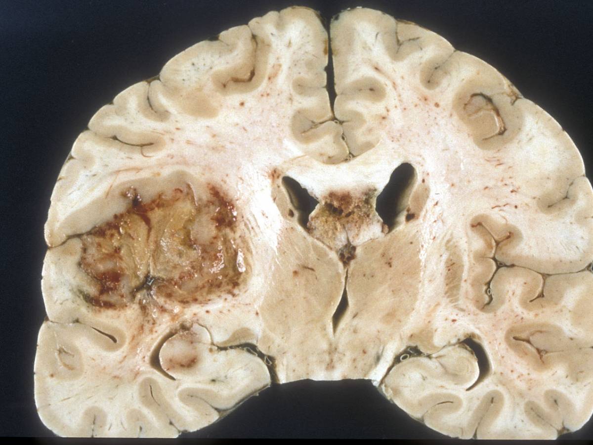 Glioblastoma, nuove speranze per la forma più grave di tumore al
