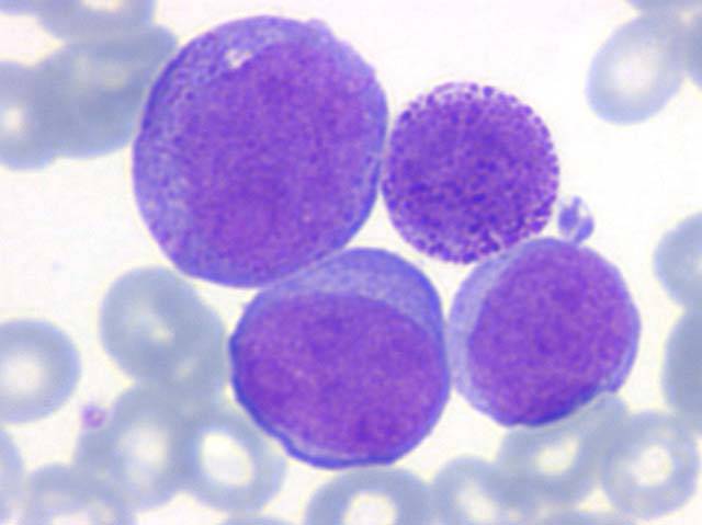 Leucemia: scoperto come attaccarla