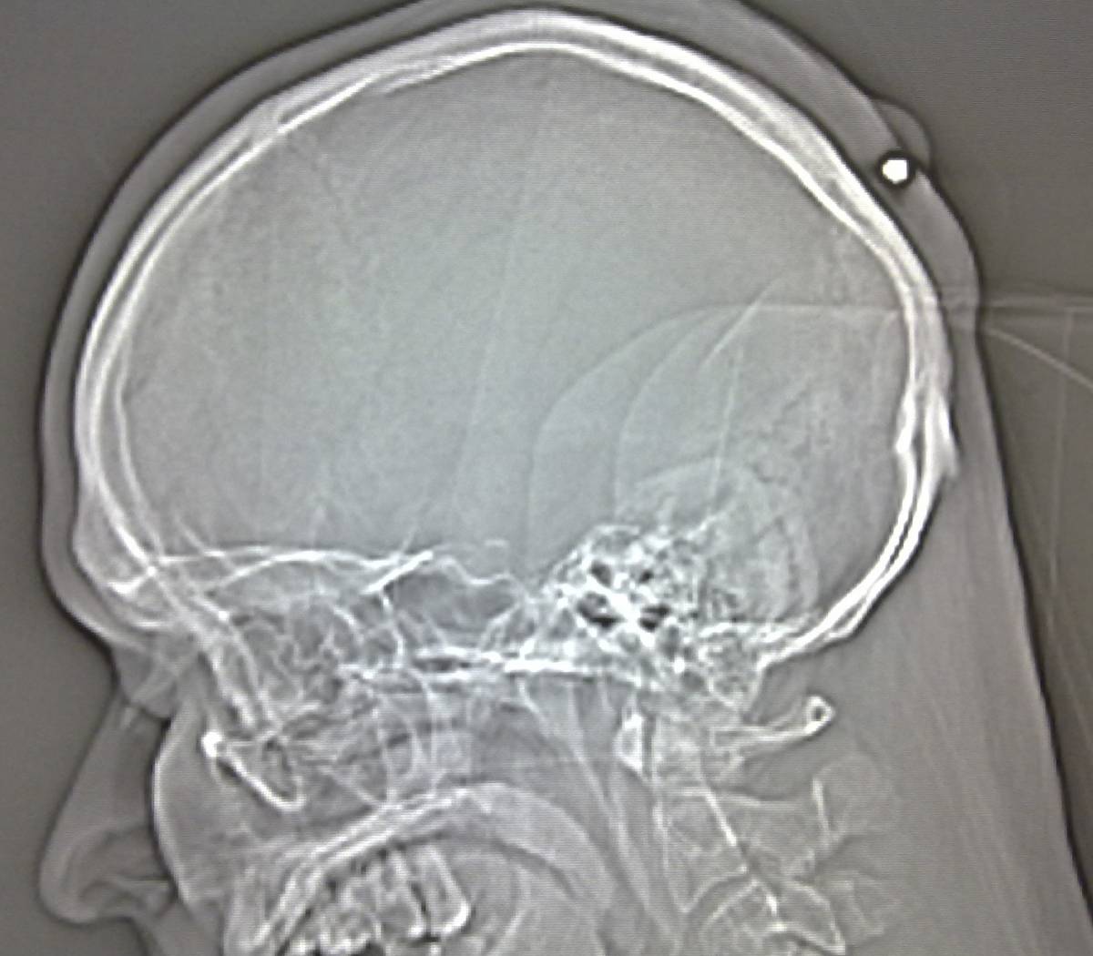 Gli sparano nella testa: 
trova proiettile dopo anni
