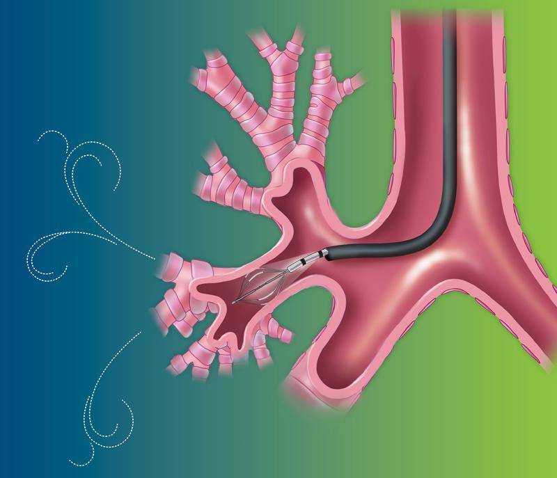 Termoplastica  bronchiale  per alleviare i casi cronici