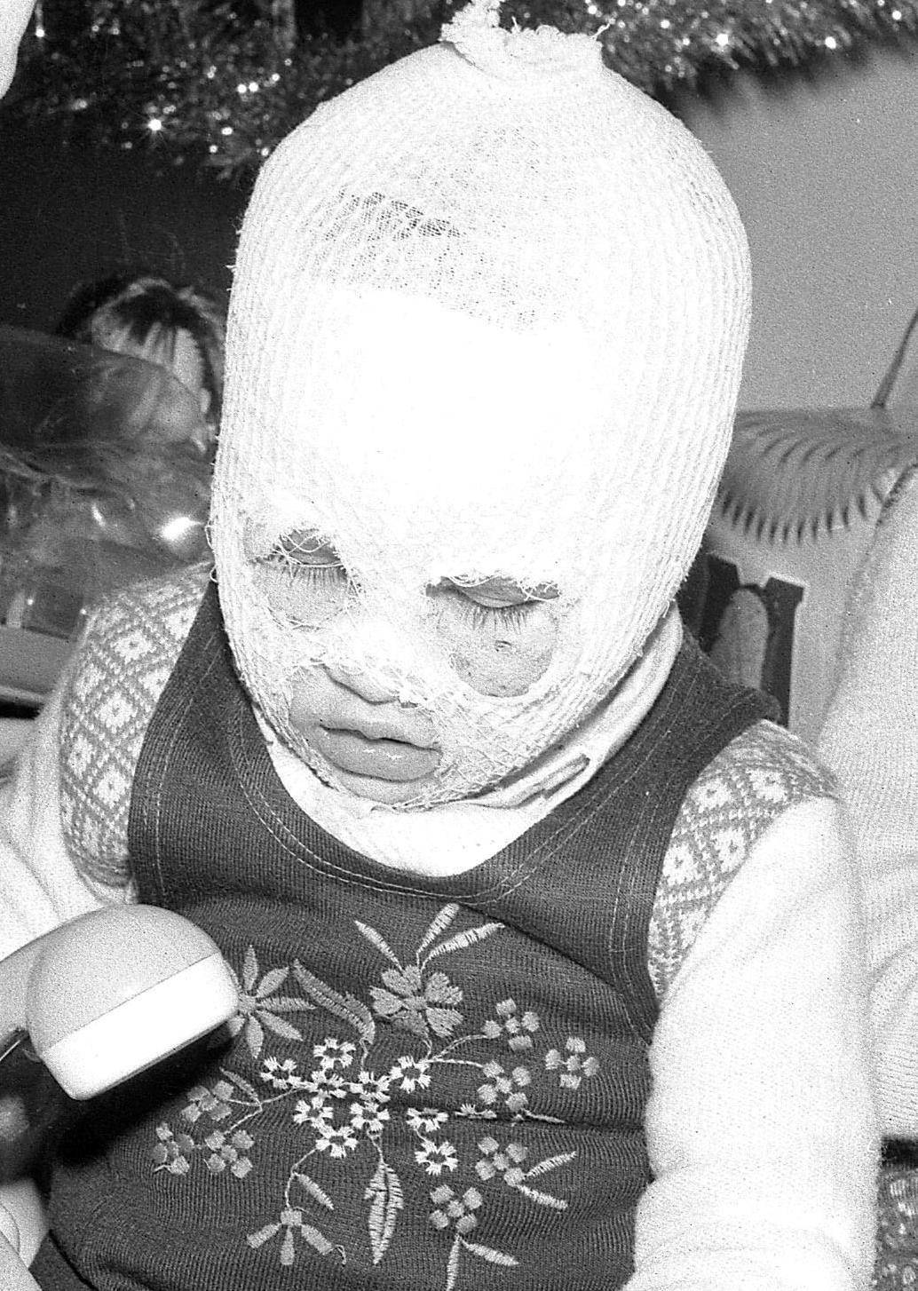 Aveva due anni e si ritrovò col viso sfigurato. Oggi è una donna bella e felice
