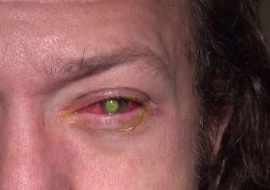 Con Le Lenti A Contatto Mentre Fa La Doccia 29enne Perde Un Occhio Ilgiornale It Lenti A Contatto Doccia